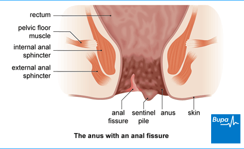best of Sphincterotomy recovery from anal