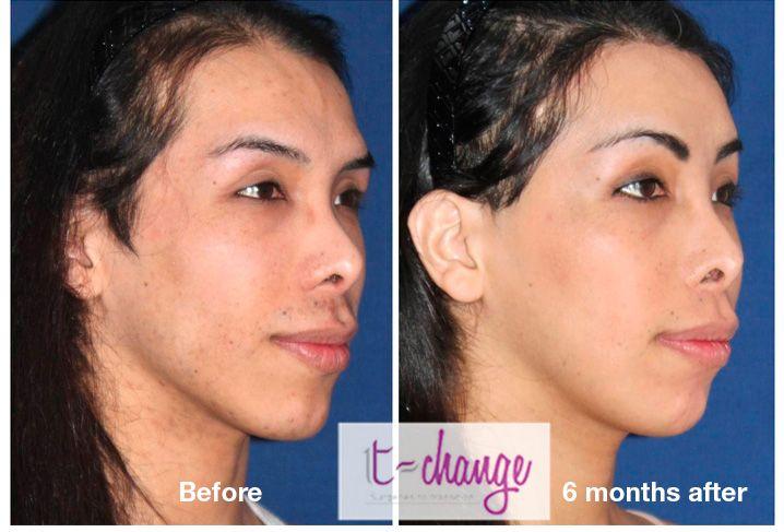 Facial feminazation surgery