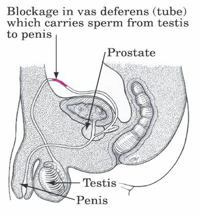 best of Blockage deferens sperm