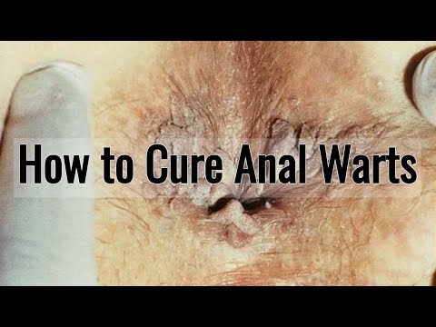 Bullet reccomend anal wart treatments