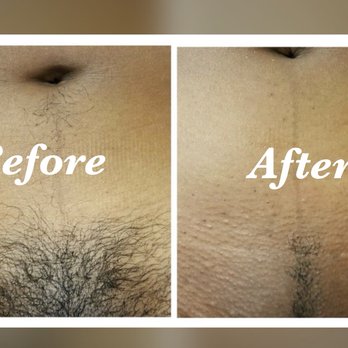 Bikini waxing before after picture