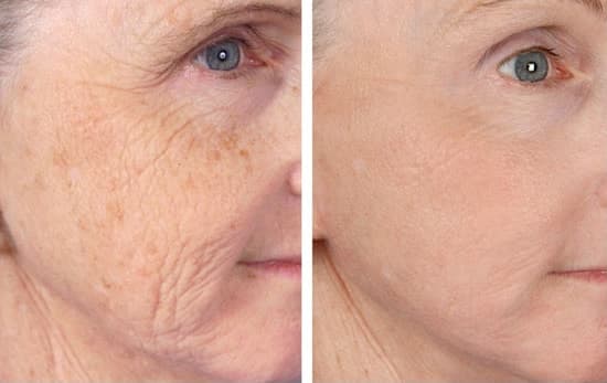 Manhattan reccomend best thing removing facial wrinkles