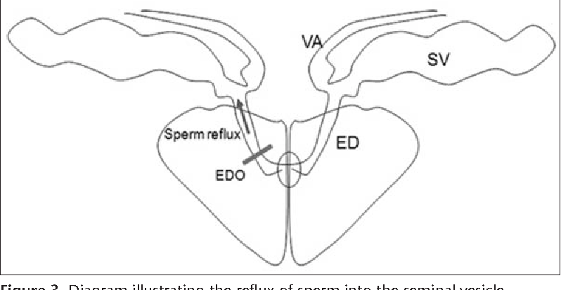Flamingo reccomend medical diagnosis sperm duct obstruction